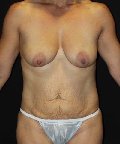 Tummy Tuck Before & After Gallery - Patient 133023702 - Image 1