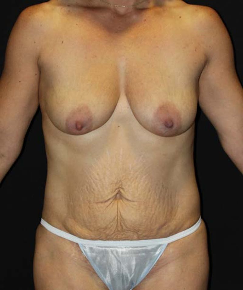 Tummy Tuck Before & After Gallery - Patient 133023702 - Image 1