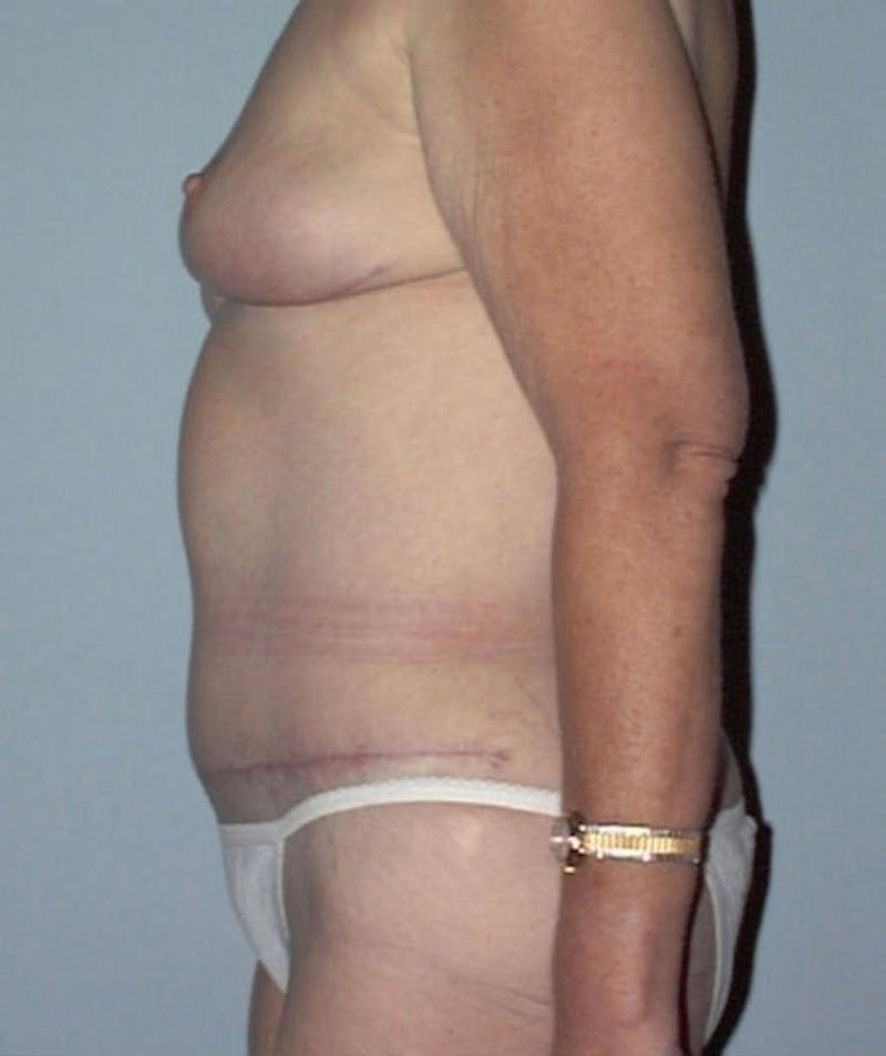 Post Weight Loss Surgery Before & After Gallery - Patient 133023701 - Image 6