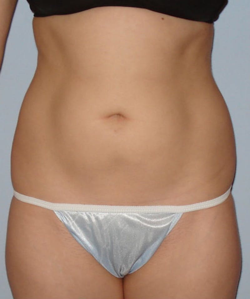 Liposuction Before & After Gallery - Patient 133023709 - Image 1