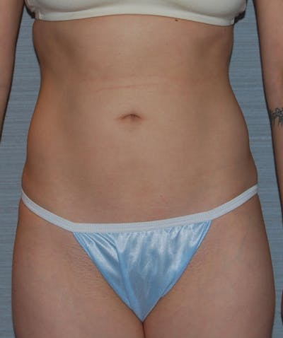 Liposuction Before & After Gallery - Patient 133023709 - Image 2