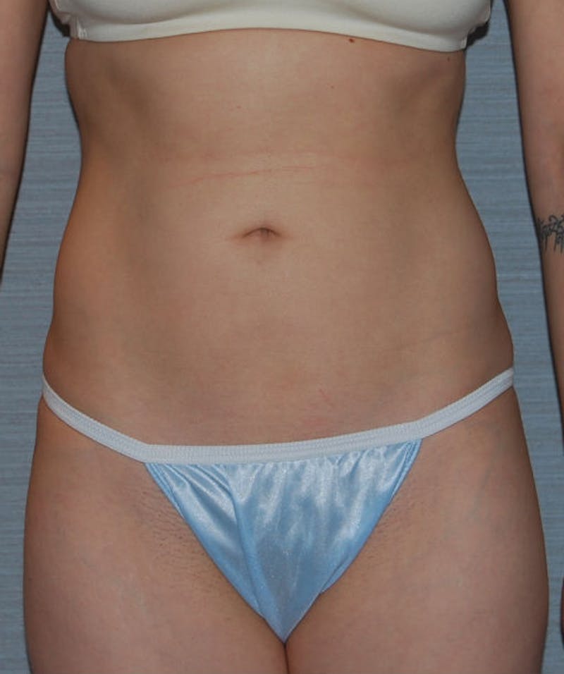 Liposuction Before & After Gallery - Patient 133023709 - Image 2