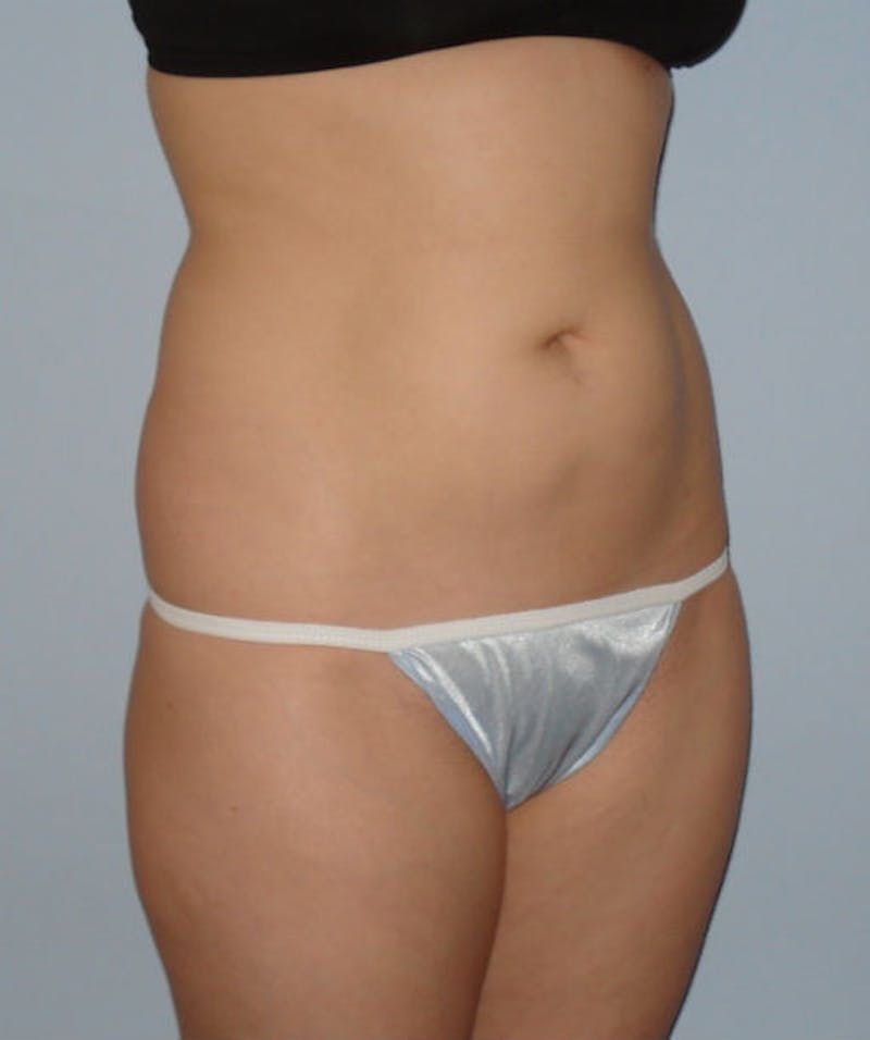 Liposuction Before & After Gallery - Patient 133023709 - Image 3