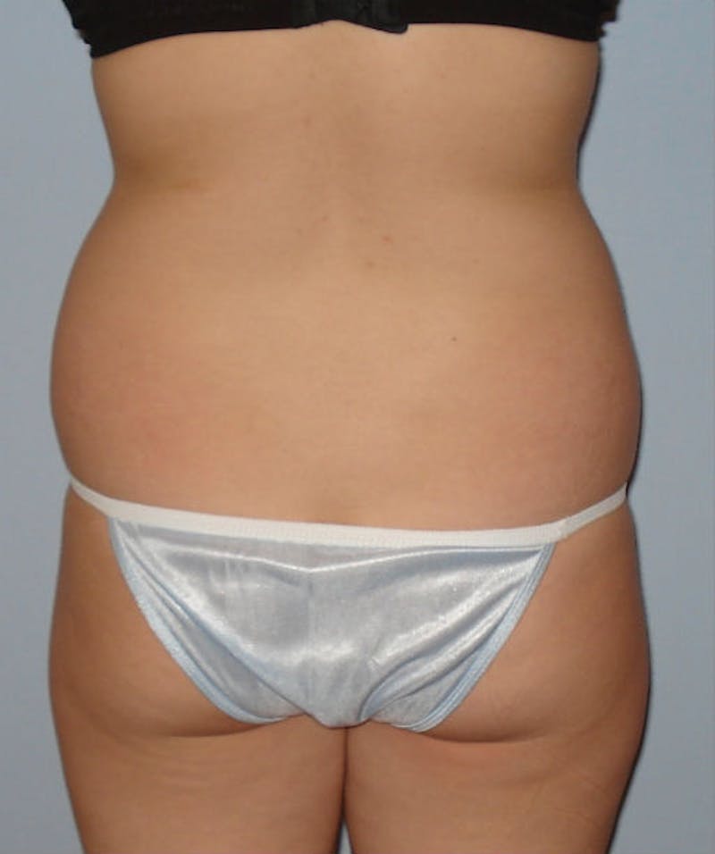 Liposuction Before & After Gallery - Patient 133023709 - Image 5