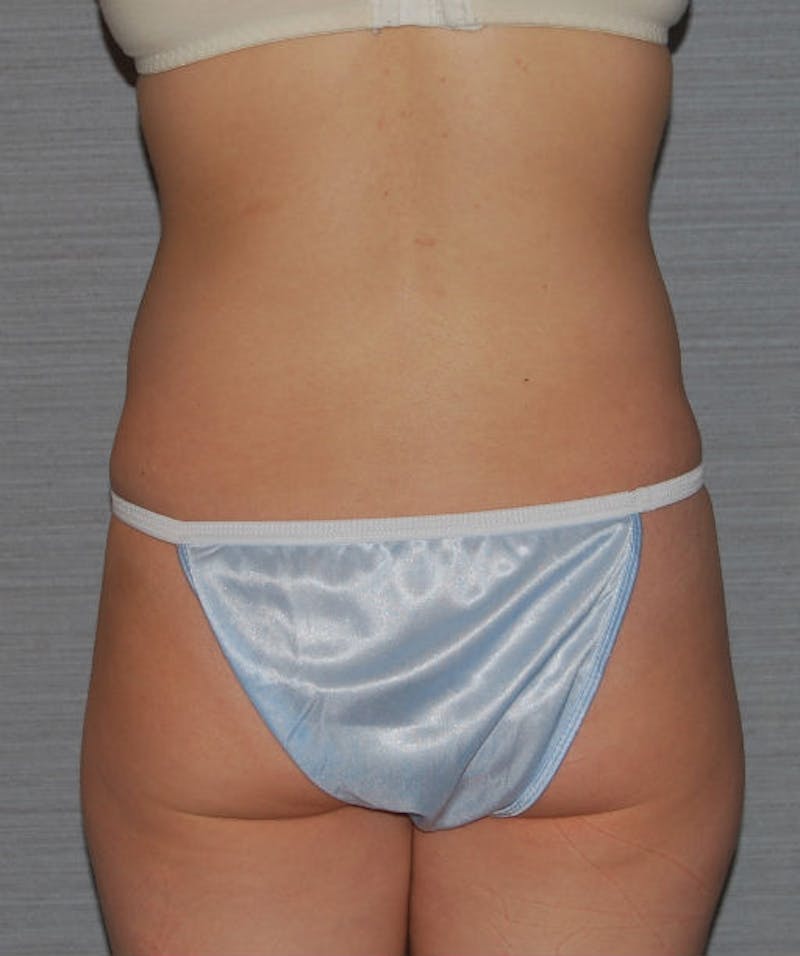 Liposuction Before & After Gallery - Patient 133023709 - Image 6