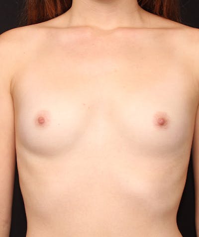 Breast Augmentation Before & After Gallery - Patient 133023717 - Image 1