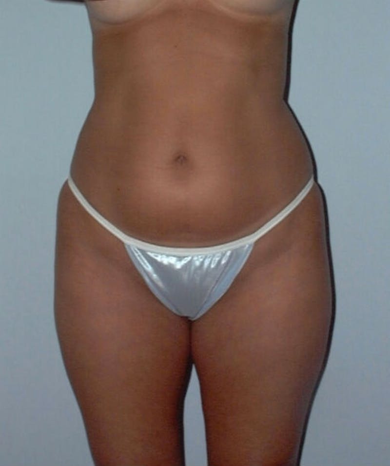 Liposuction Before & After Gallery - Patient 133023715 - Image 1