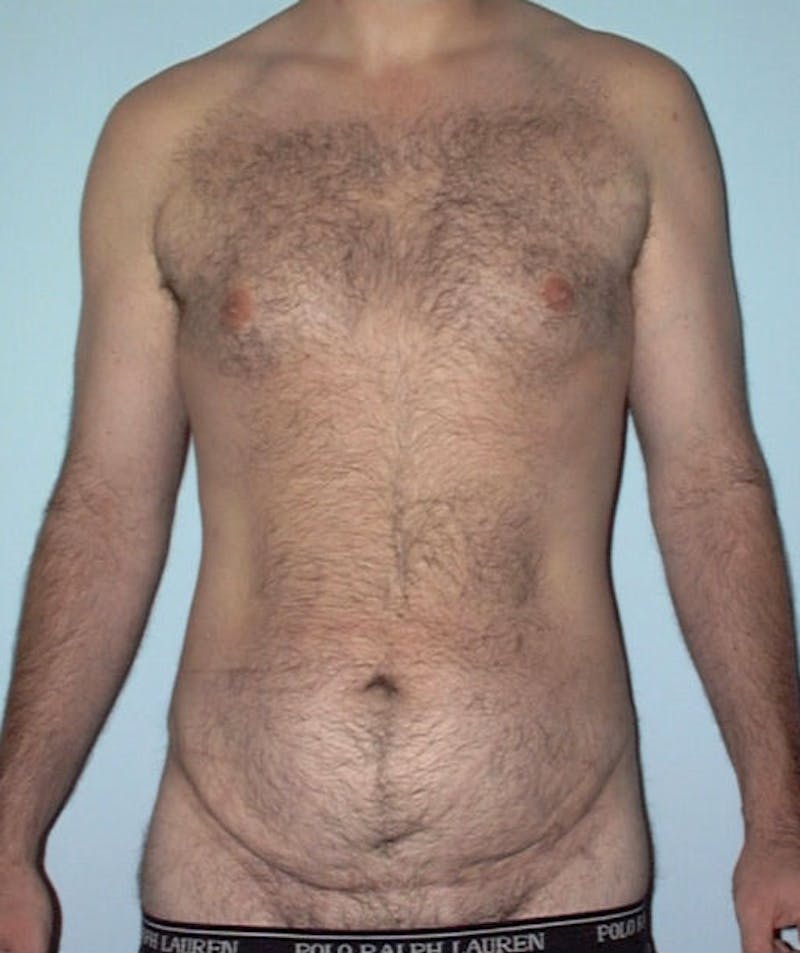 Post Weight Loss Surgery Before & After Gallery - Patient 133023716 - Image 1