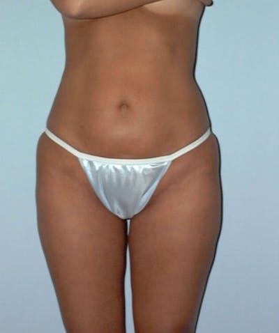 Liposuction Before & After Gallery - Patient 133023715 - Image 2