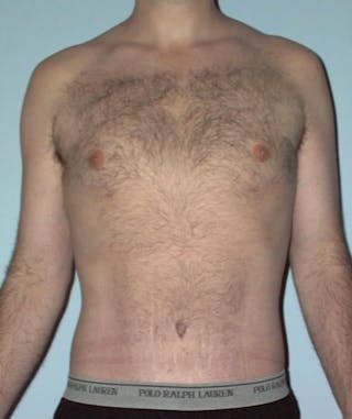 Post Weight Loss Surgery Before & After Gallery - Patient 133023716 - Image 2