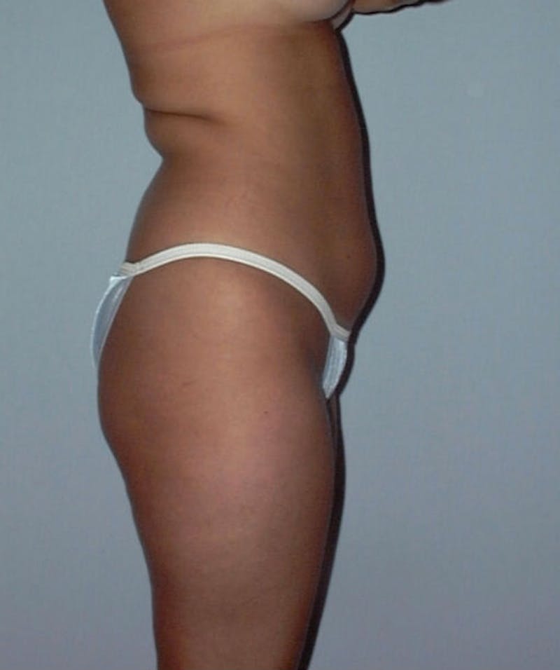 Liposuction Before & After Gallery - Patient 133023715 - Image 3