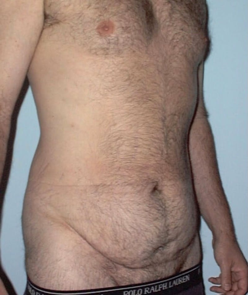 Post Weight Loss Surgery Before & After Gallery - Patient 133023716 - Image 3