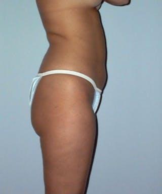 Liposuction Before & After Gallery - Patient 133023715 - Image 4