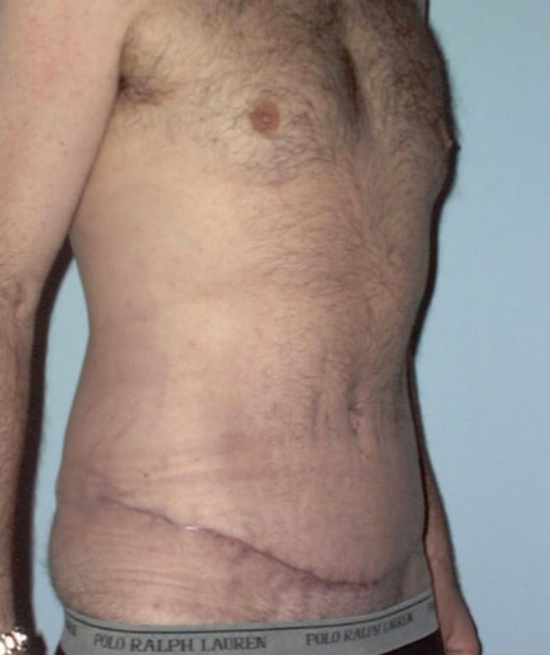 Post Weight Loss Surgery Before & After Gallery - Patient 133023716 - Image 4