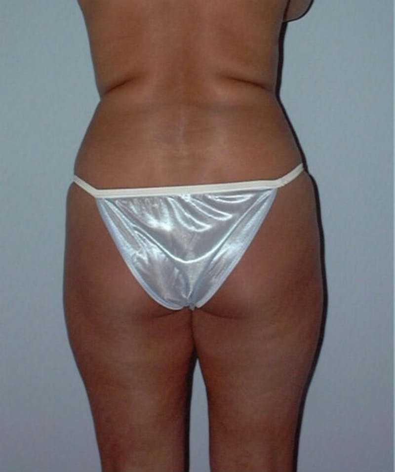 Liposuction Before & After Gallery - Patient 133023715 - Image 5