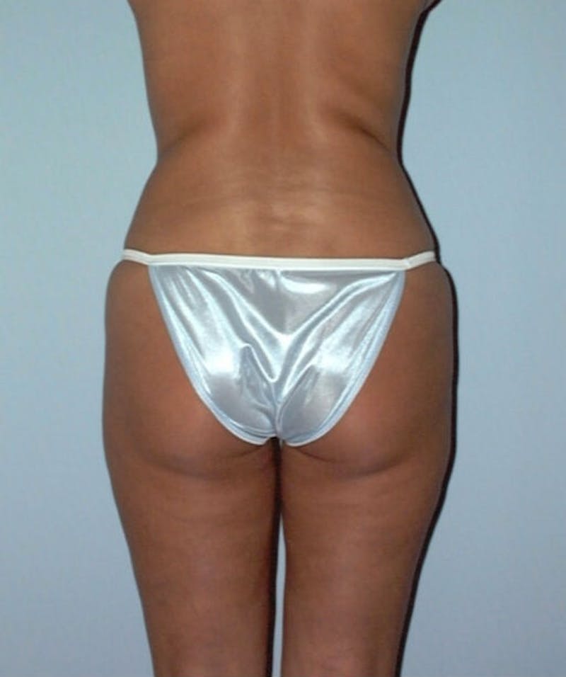 Liposuction Before & After Gallery - Patient 133023715 - Image 6