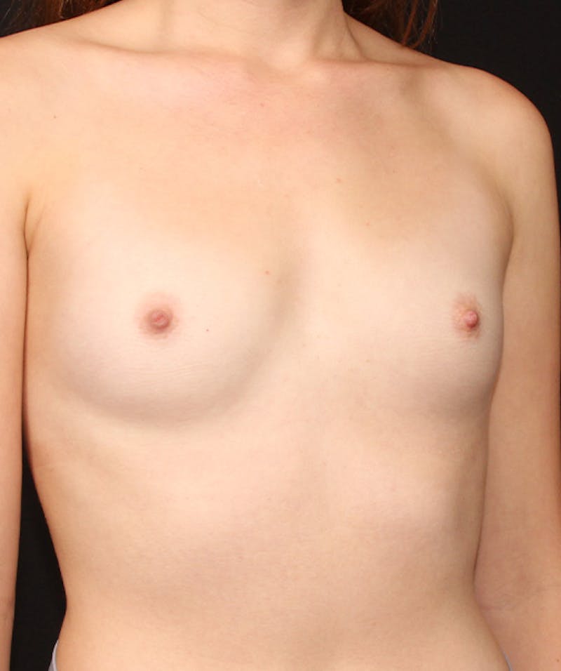Breast Augmentation Before & After Gallery - Patient 133023717 - Image 7