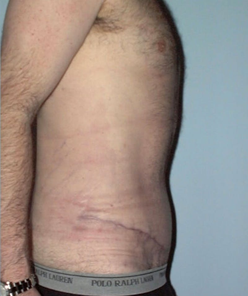 Post Weight Loss Surgery Before & After Gallery - Patient 133023716 - Image 6