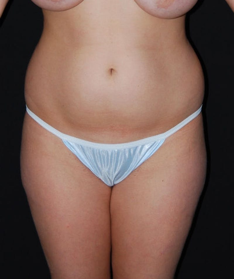 Liposuction Before & After Gallery - Patient 133023724 - Image 1