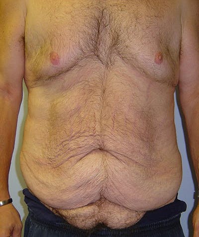 Post Weight Loss Surgery Before & After Gallery - Patient 133023730 - Image 1