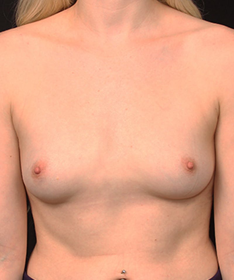 Breast Augmentation Before & After Gallery - Patient 133023731 - Image 1
