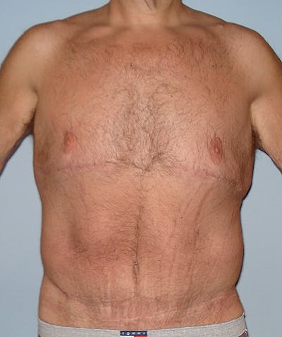Post Weight Loss Surgery Before & After Gallery - Patient 133023730 - Image 2