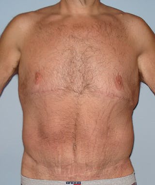 Post Weight Loss Surgery Before & After Gallery - Patient 133023730 - Image 2