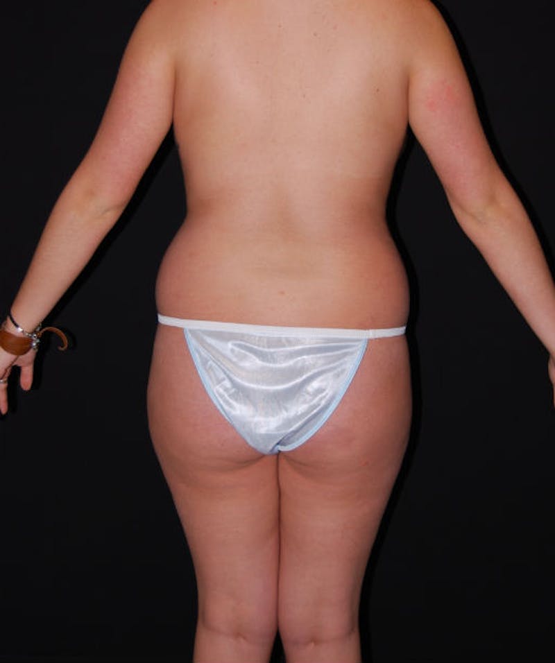 Liposuction Before & After Gallery - Patient 133023724 - Image 5