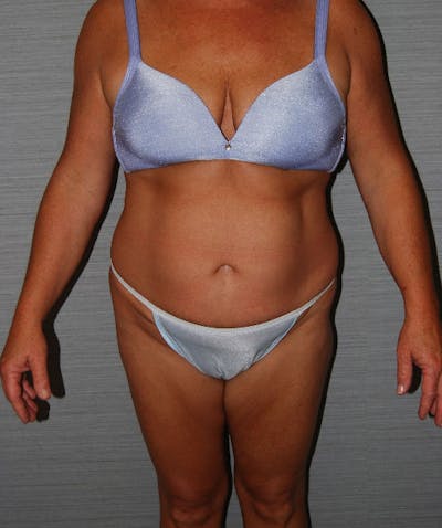 Tummy Tuck Before & After Gallery - Patient 133023729 - Image 1