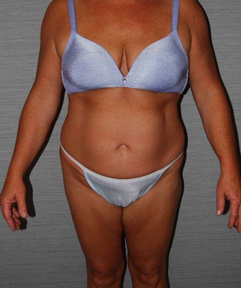 Tummy Tuck Before & After Gallery - Patient 133023729 - Image 1