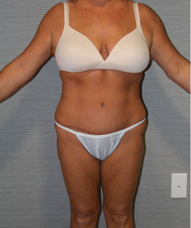 Tummy Tuck Before & After Gallery - Patient 133023729 - Image 2