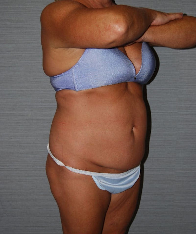 Tummy Tuck Before & After Gallery - Patient 133023729 - Image 3