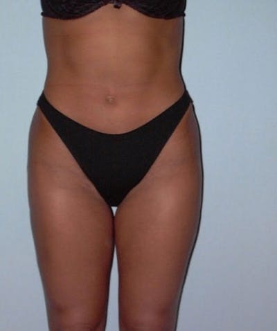 Liposuction Before & After Gallery - Patient 133023727 - Image 2