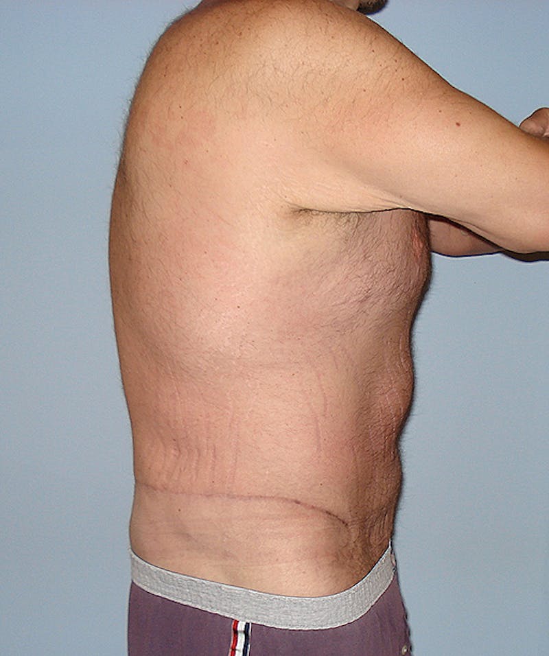 Post Weight Loss Surgery Before & After Gallery - Patient 133023730 - Image 4