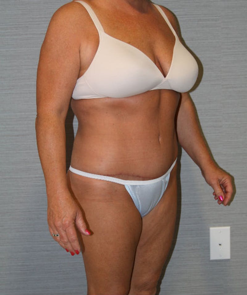 Tummy Tuck Before & After Gallery - Patient 133023729 - Image 4