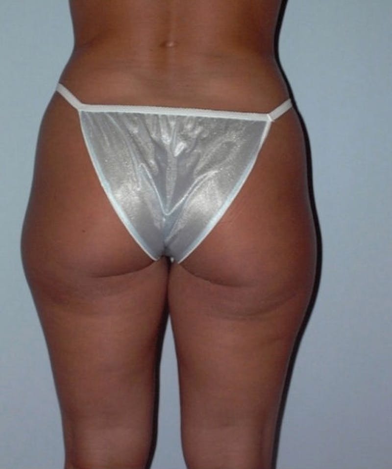 Liposuction Before & After Gallery - Patient 133023727 - Image 3