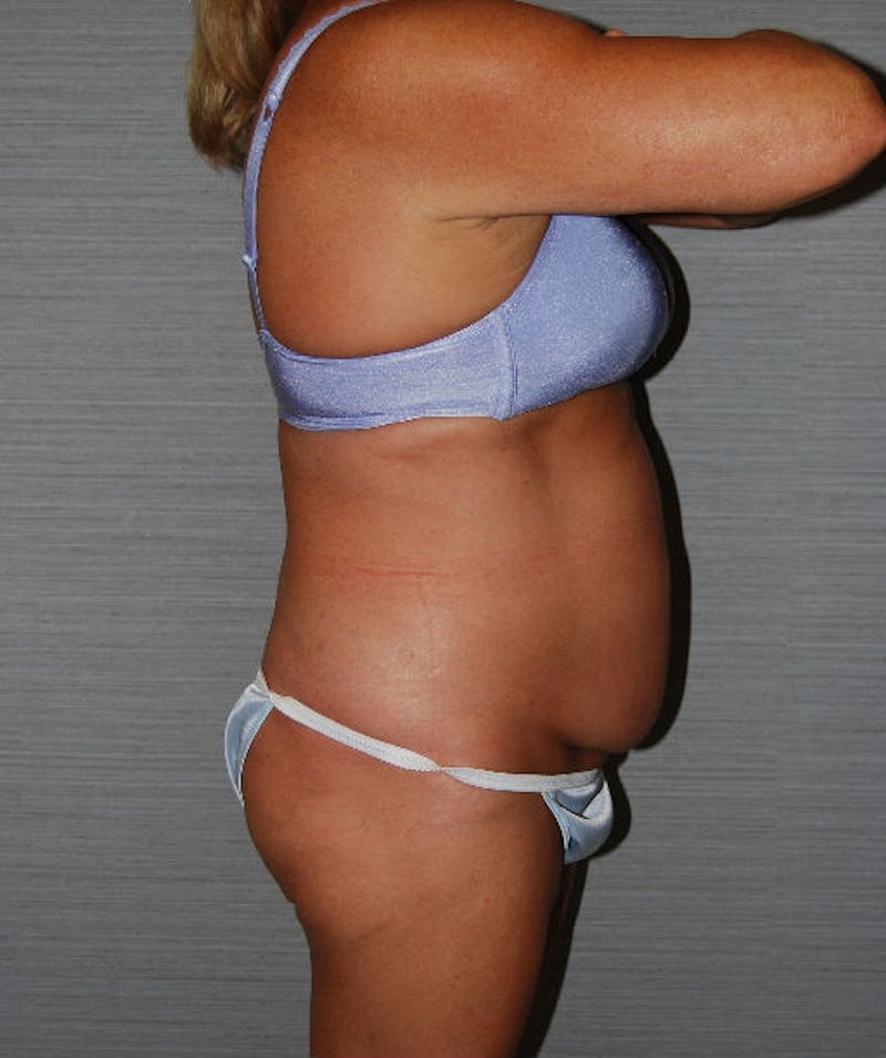 Tummy Tuck Before & After Gallery - Patient 133023729 - Image 5
