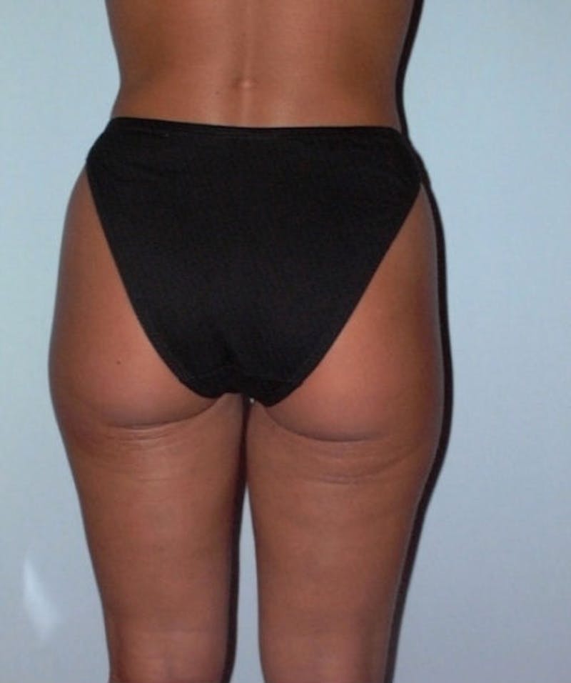 Liposuction Before & After Gallery - Patient 133023727 - Image 4