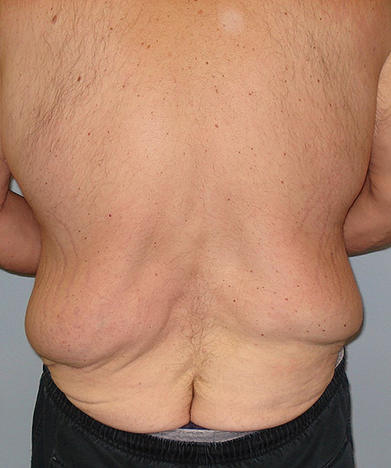 Post Weight Loss Surgery Before & After Gallery - Patient 133023730 - Image 5