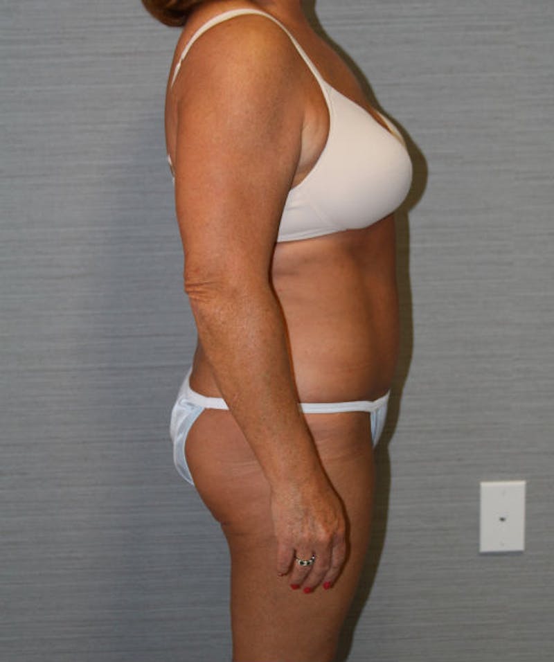 Tummy Tuck Before & After Gallery - Patient 133023729 - Image 6