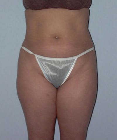 Liposuction Before & After Gallery - Patient 133023732 - Image 1