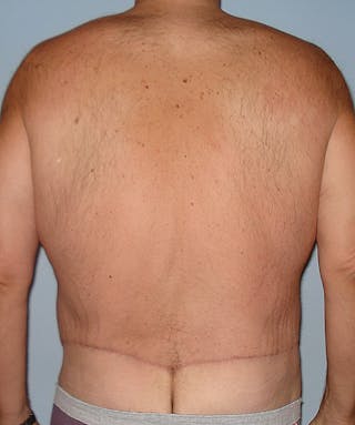 Post Weight Loss Surgery Before & After Gallery - Patient 133023730 - Image 6