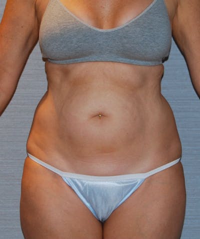 Tummy Tuck Before & After Gallery - Patient 133023734 - Image 1