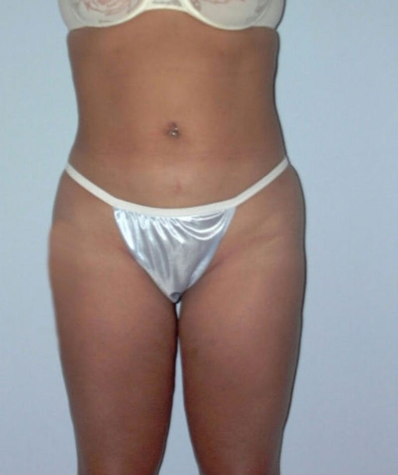 Liposuction Before & After Gallery - Patient 133023732 - Image 2