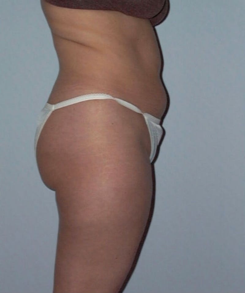 Liposuction Before & After Gallery - Patient 133023732 - Image 3
