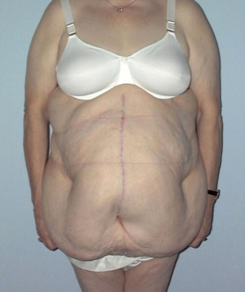 Post Weight Loss Surgery Before & After Gallery - Patient 133023733 - Image 1