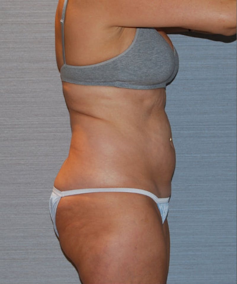 Tummy Tuck Before & After Gallery - Patient 133023734 - Image 3