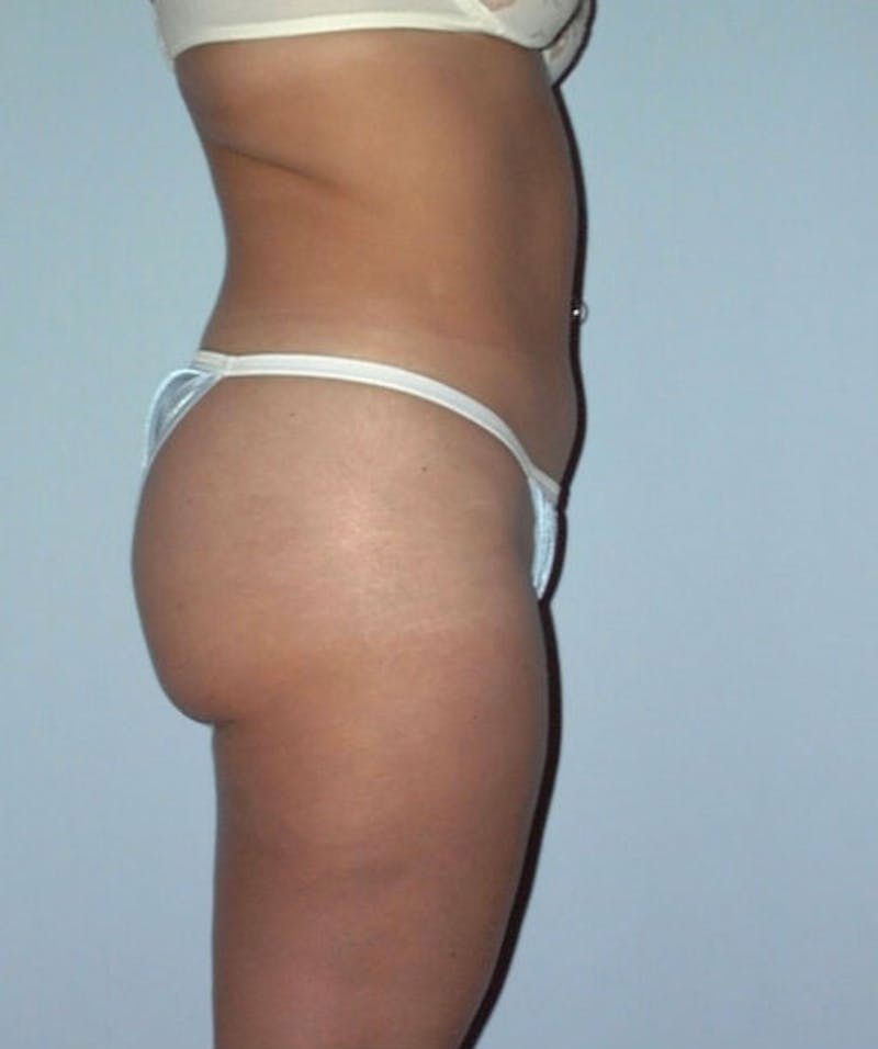Liposuction Before & After Gallery - Patient 133023732 - Image 4