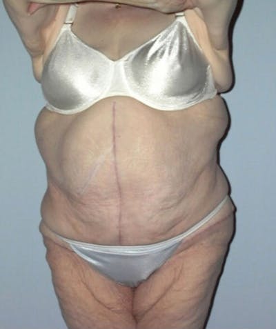 Post Weight Loss Surgery Before & After Gallery - Patient 133023733 - Image 2