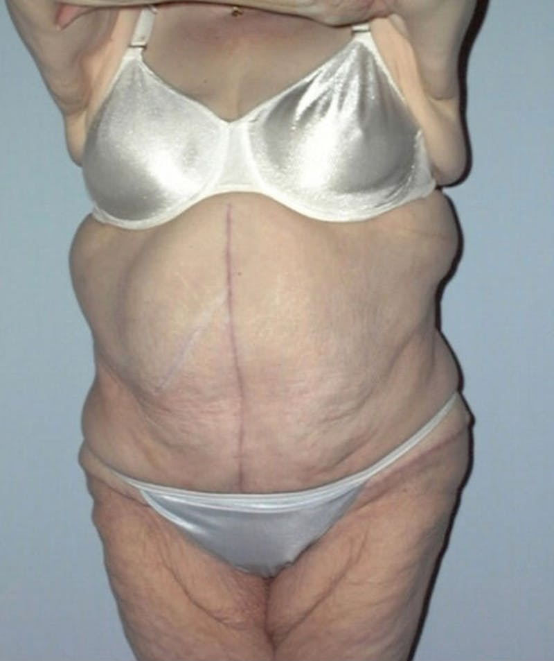 Post Weight Loss Surgery Before & After Gallery - Patient 133023733 - Image 2